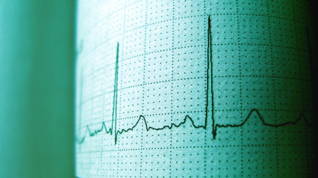 Close-up of an ECG printout displaying heartbeat rhythm and frequency for medical analysis.